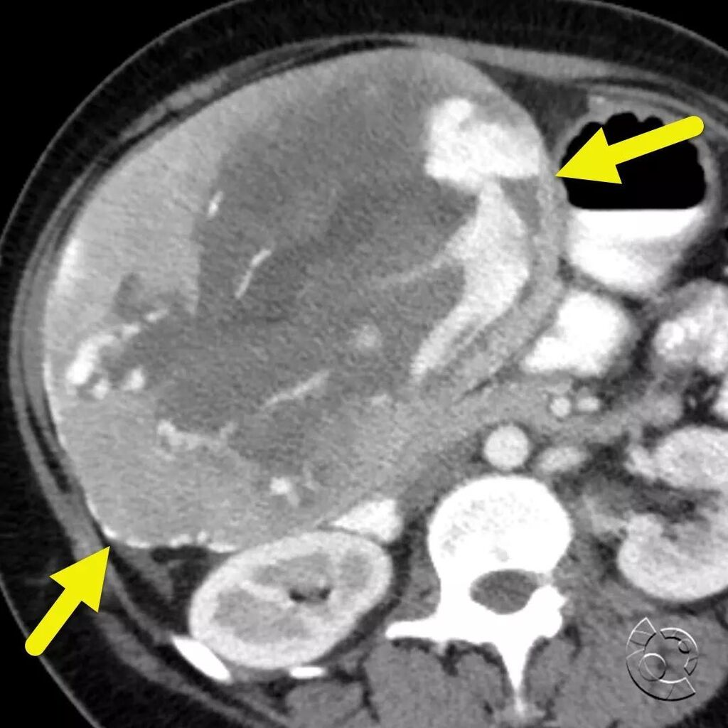 CincyKidsRad's tweet photo. Axial (image 1), coronal (image 2), and sagittal (image 3) contrast-enhanced CT shows a large heterogeneous mass (arrow) arising from the inferior margin of the liver. The mass is mostly solid but has large vascular spaces and a central nonenhancing comp… https://t.co/iibUx0GVJD https://t.co/xWY5LQrgzA