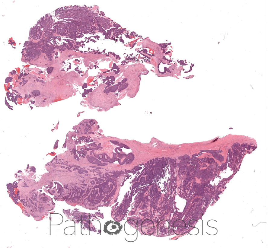 @theBSOMP Case of the Month for May 2023 is now live. Visit bsomp.org.uk/cotm for case history, histology wholeslide image, diagnosis & learning points. #bsomp #COTM #oralpathology #headandneckpathology #pathology #pathogenesisdigitalpathology @pathogenesisDP