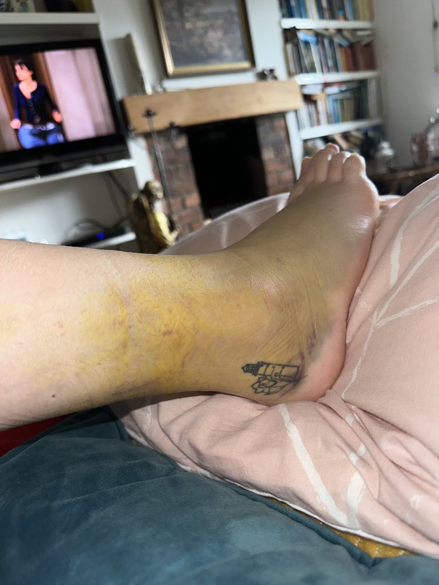 PhysioLlion's tweet photo. I have increased respect for air boots now 😂 ATFL and CFL ligament tearing, Waiting for MRI referral to assess grading. Did a proper good job of it, netball season definitely over… Now onto self rehabilitation 🥹💔 https://t.co/2Wb0oGBlmE