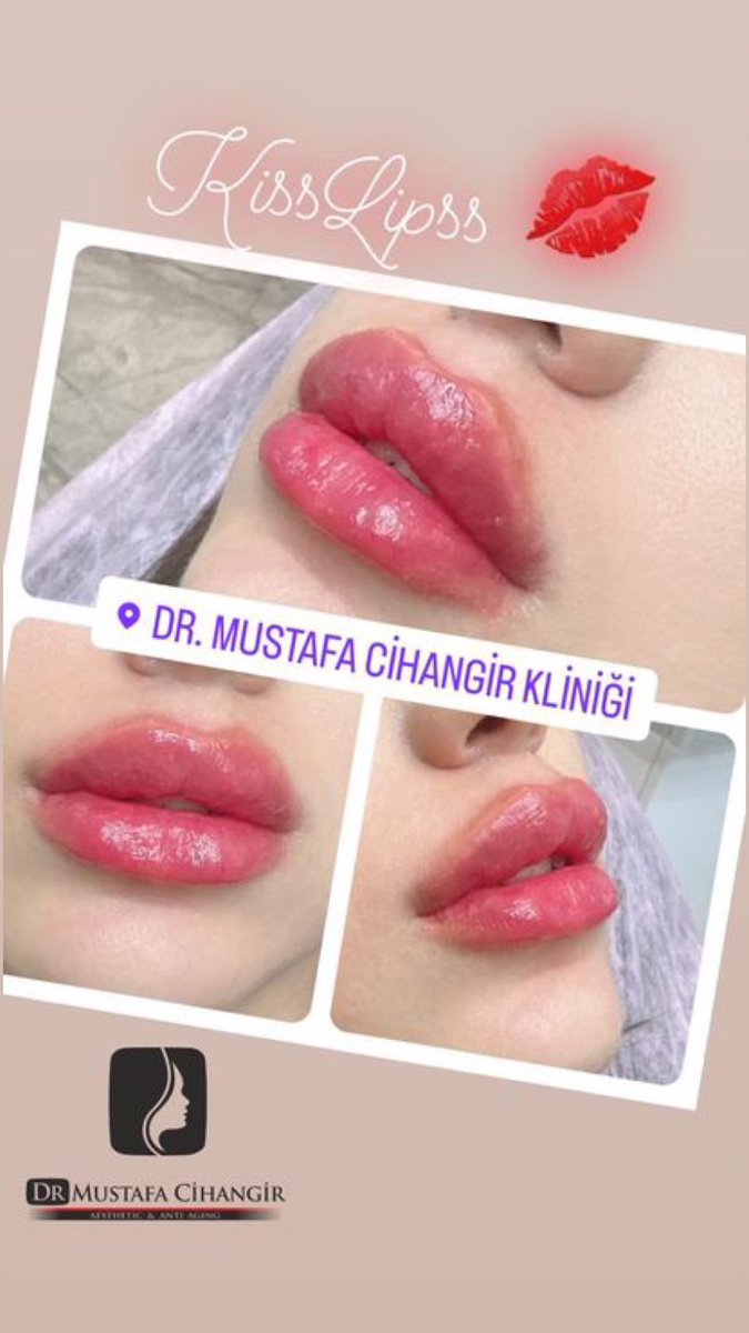 drmcihangir's tweet photo. DUDAK DOLGUSU 💋 
#KissLipss #dudakdolgusu #burundolgusu #çenedolgusu #şakakdolgusu #Adana https://t.co/6pMjwbhea8