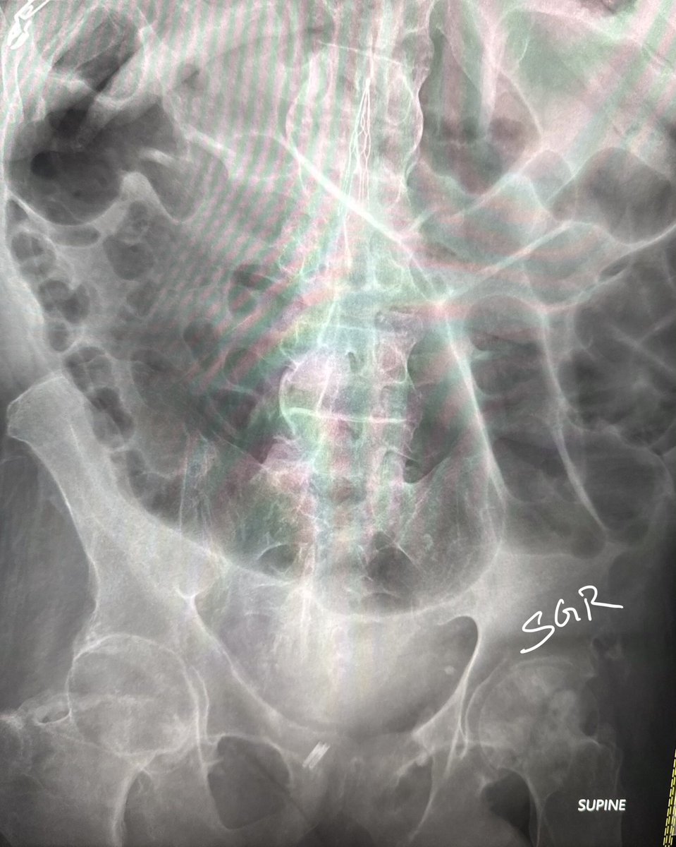 Let’s continue with some ‘basic’ Xray. #MedTwitter #radtwitter #surgerytwitter #EdTwitter what’s your diagnosis?