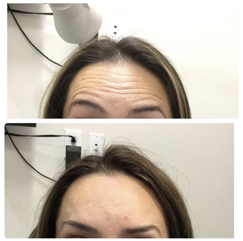 BOTOX BY PBJ 🦋 
.
.
.
.
.
.
.
.
#oculoplastics #asoprs #ophthalmology #plasticsurgery #optometry #blepharoplasty #lidlift #cosmeticsurgery #eyelidsurgery #bleph #beforeandafter #botox #face #facialplastics #gay #gaydoctor #injector #surgeon #cherryhill #cherryhillnj #villanova