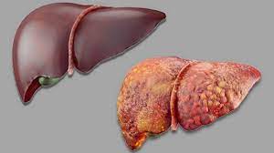 #Liver_failure occurs either acute or chronic. Causes include a reaction to #medication, high doses of acetaminophen or paracetamol, #hepatitis_infection, alcohol abuse and advanced #fatty_liver.
