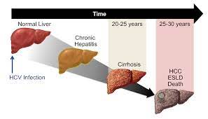 #Chronic_hepatitis causes the #liver to become inflamed for at least six months. Hepatitis is an inflammatory condition affecting the liver. When #liver_inflammation persists for at least six months, it's referred to as chronic hepatitis.