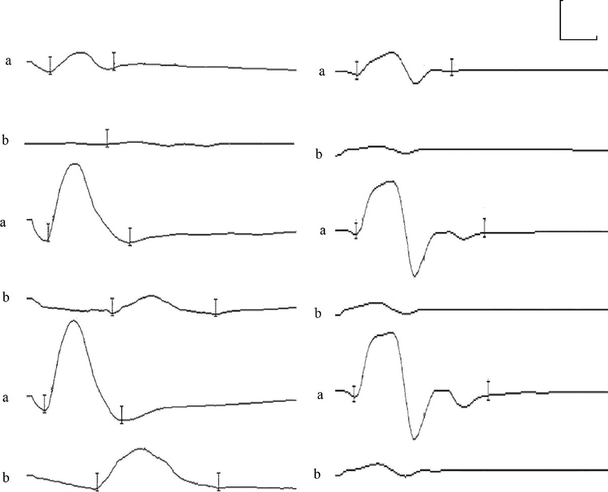 ClinicalNeuroph's tweet photo. [H reflex in ALS] Libonati et al. suggested that the heteronymous H reflex, as obtained by the masseteric nerve's stimulation, was present far more often in ALS patients than in healthy people.

https://t.co/fUu8NVGYNH
#ALS #Hreflex #ClinicalNeuroph https://t.co/Is1oYOIud9