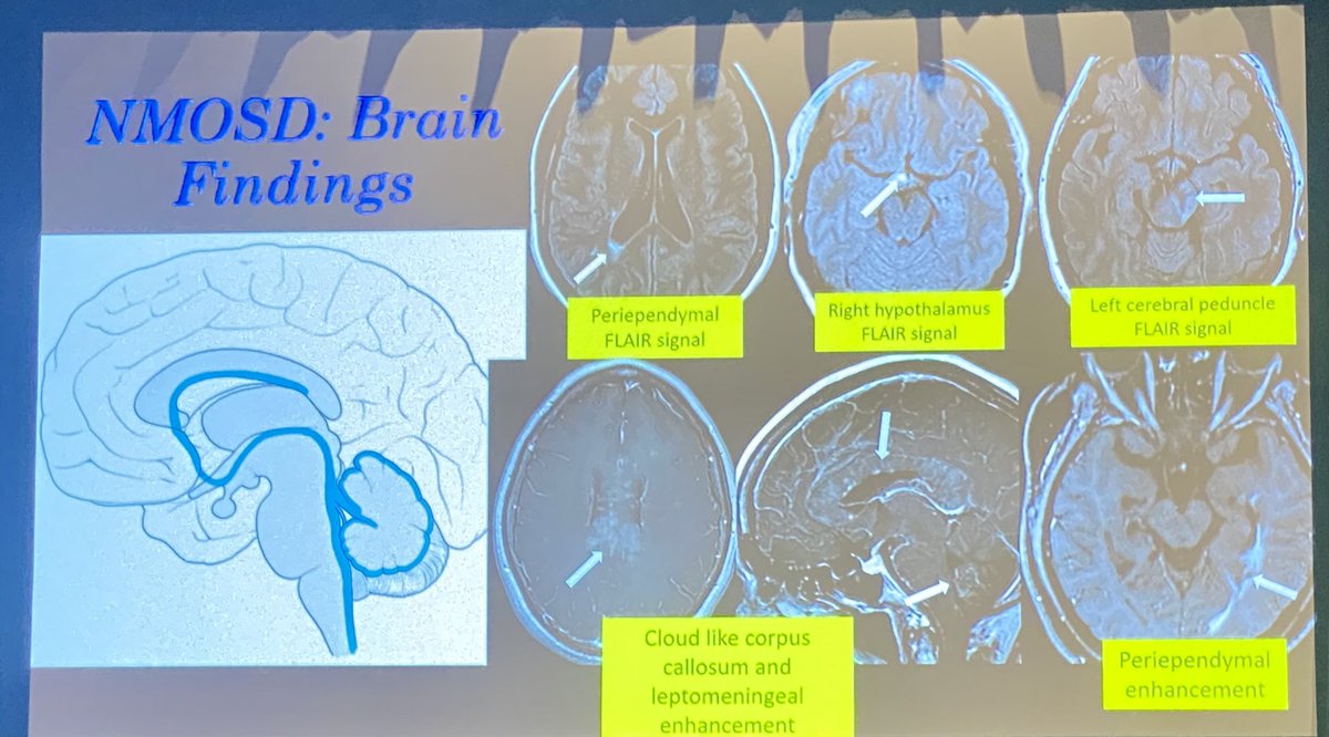 Maria Gule-Monroe MD (@mariagulemonroe) on Twitter photo Another excellent talk by <a href="/CMLincolnMD/">Christie M. Malayil Lincoln</a> on demyelination imaging. Great examples of central vein sign in MS and brain findings in NMO #ASNR23 Another excellent talk by <a href="/CMLincolnMD/">Christie M. Malayil Lincoln</a> on demyelination imaging. Great examples of central vein sign in MS and brain findings in NMO #ASNR23