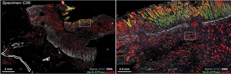 Later this month (5/24), join us for a @Nature hosted webinar by @sorger_peter (@harvardmed) and learn how the Orion #spatialbiology imaging platform was used to identify prognostic signatures of #colorectalcancer: Save your seat! ➡️workcast.com/register?cpak=…