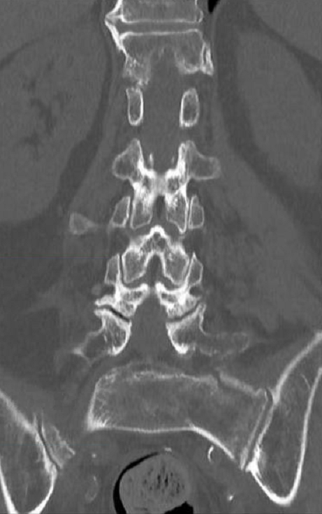 CT of the lumbar spine obtained due to intractable back pain. Do you see the fracture?

#radiology #ortho #radtwitter #orthotwitter #orthopedics #MSK #musculoskeletal #fracture #CT #spine #lumbarspine