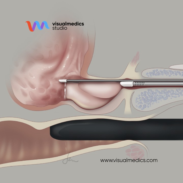 #TBT of a nice color palette used for a surgical intervention called "acquablation". Aquablation therapy is an advanced, minimally invasive BPH treatment that uses the power of water delivered with robotic precision. It's a long-lasting solution with low rates of irreversible com