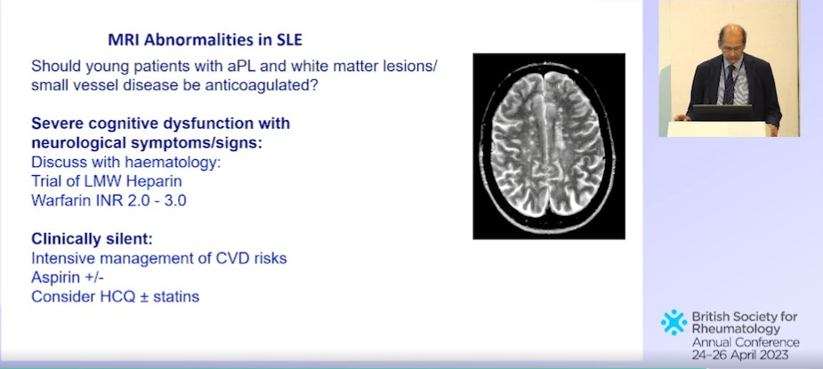debaditya_roy's tweet photo. 🦋🧠#Lupus #NPSLE #BSR23 
#Wonderful session by Dr David D'Cruz☀️

💫DO NOT forget the #mimics
💫Lupus #Vasculitis is rare BUT have high mortality
💫Know the #MRA Pointers in vasculitis👇
💫Is it related to #APS?To Anticoagulate or Not?👇

🔥Check out the summary slide below!
1/2 https://t.co/Kp4it7rygR