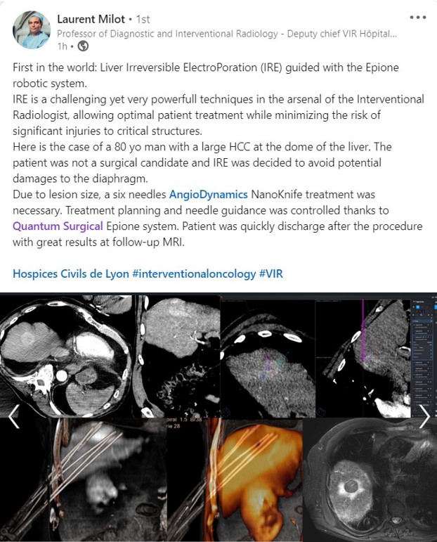 AndrewRoboticIO's tweet image. I was on the launch team for #NanoKnife in 2008 and now representing #Epione Robot it brings me great joy to see these 2 technologies used in conjunction for the FIRST TIME EVER in the world!!! 

Great work Prof. Laurent Milot! 
 #AngioDynamics  #QuantumSurgical #ablation #IRE