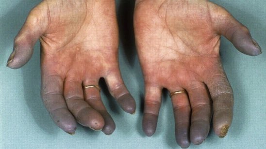 BrownJHM's tweet photo. Diagnosis? Long hx of smoking + (Image Hindustan Times) https://t.co/tit7J0ptXi