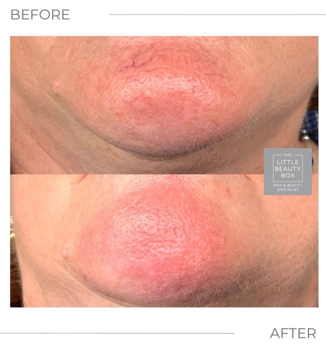 thermavein's tweet photo. ThermaVein only targets the vein, making it the safe, accurate & effective treatment for spider veins with reproducible results.
Email: info@thermavein.com
#thermavein #spiderveins #threadveins #veins #aesthetics #beauty #IPL #Laser
Photo by the wonderful @BeautyBoxLowton https://t.co/aJOFLH9hvu