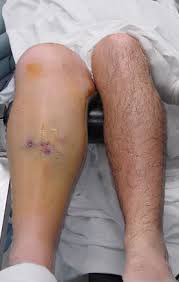 BrownJHM's tweet photo. Pain out of proportion to injury and paresthesias +. Diagnosis? (Image Orthopedia) #Medtwitter https://t.co/ENwSXEWaFv