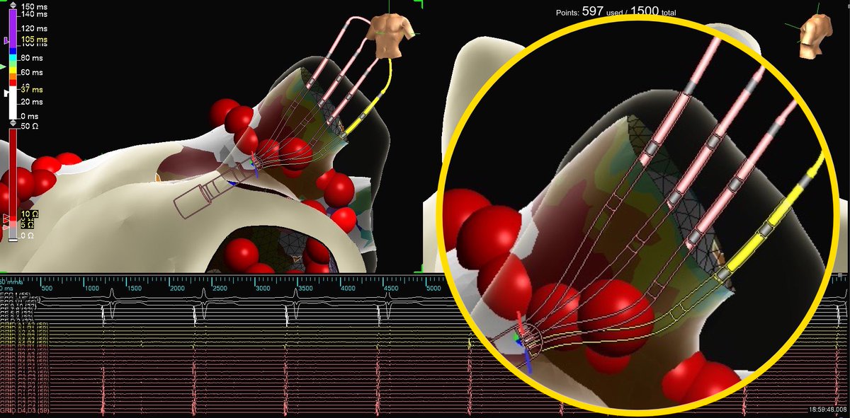 PVC_on_HERS's tweet photo. Nearfield or farfield, #EPeeps?

1. #EnSiteX’s nearfield detection algorithm used in conjunction with #EmphasisMaps.

2. #PeakFrequency of 250Hz de-emphasizing the farfield component of the LSPV.

3. Independent 🔥 on #HDGrid. 

#WelcomeToTheTParty @senthil_dorai @AbbottCardio https://t.co/NOnLe0Vs2x