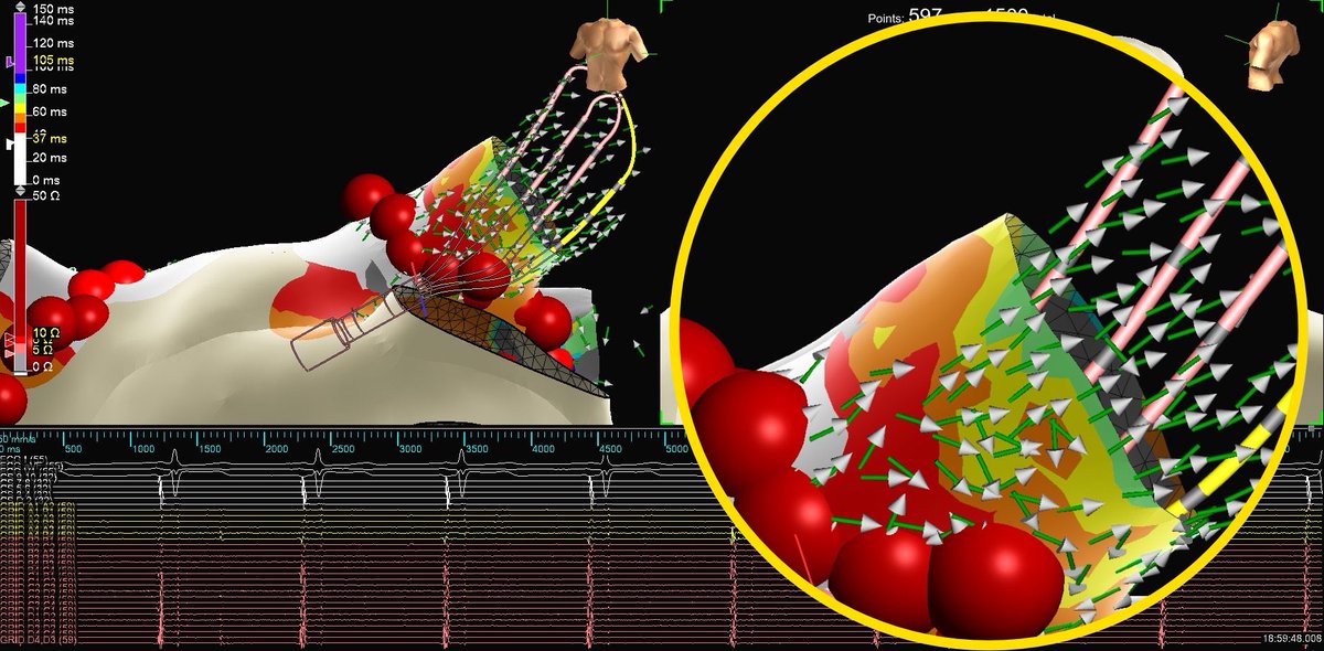 PVC_on_HERS's tweet photo. Nearfield or farfield, #EPeeps?

1. #EnSiteX’s nearfield detection algorithm used in conjunction with #EmphasisMaps.

2. #PeakFrequency of 250Hz de-emphasizing the farfield component of the LSPV.

3. Independent 🔥 on #HDGrid. 

#WelcomeToTheTParty @senthil_dorai @AbbottCardio https://t.co/NOnLe0Vs2x