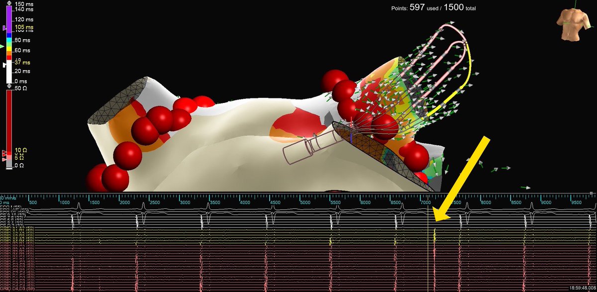 PVC_on_HERS's tweet photo. Nearfield or farfield, #EPeeps?

1. #EnSiteX’s nearfield detection algorithm used in conjunction with #EmphasisMaps.

2. #PeakFrequency of 250Hz de-emphasizing the farfield component of the LSPV.

3. Independent 🔥 on #HDGrid. 

#WelcomeToTheTParty @senthil_dorai @AbbottCardio https://t.co/NOnLe0Vs2x