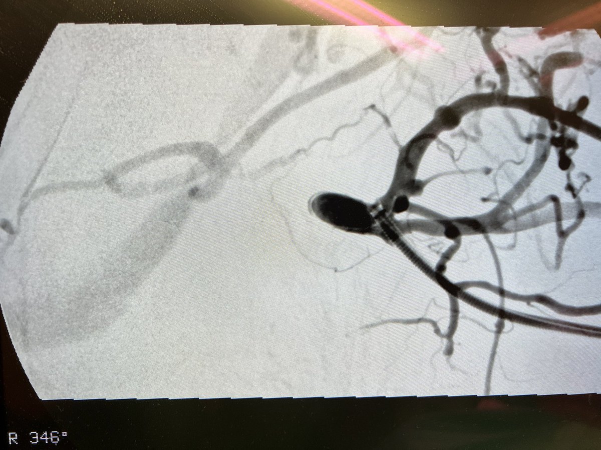 robshahverdyan's tweet photo. Now you see me, now you don’t. #TCVO #subclavian #ESKD #recan #dialysis #DCB https://t.co/Ofs6qh2At3
