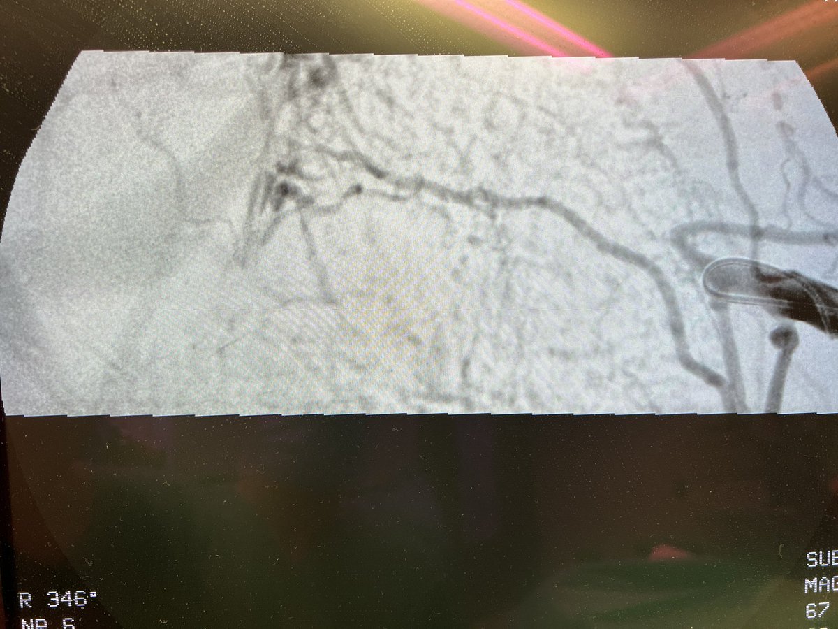 robshahverdyan's tweet photo. Now you see me, now you don’t. #TCVO #subclavian #ESKD #recan #dialysis #DCB https://t.co/Ofs6qh2At3