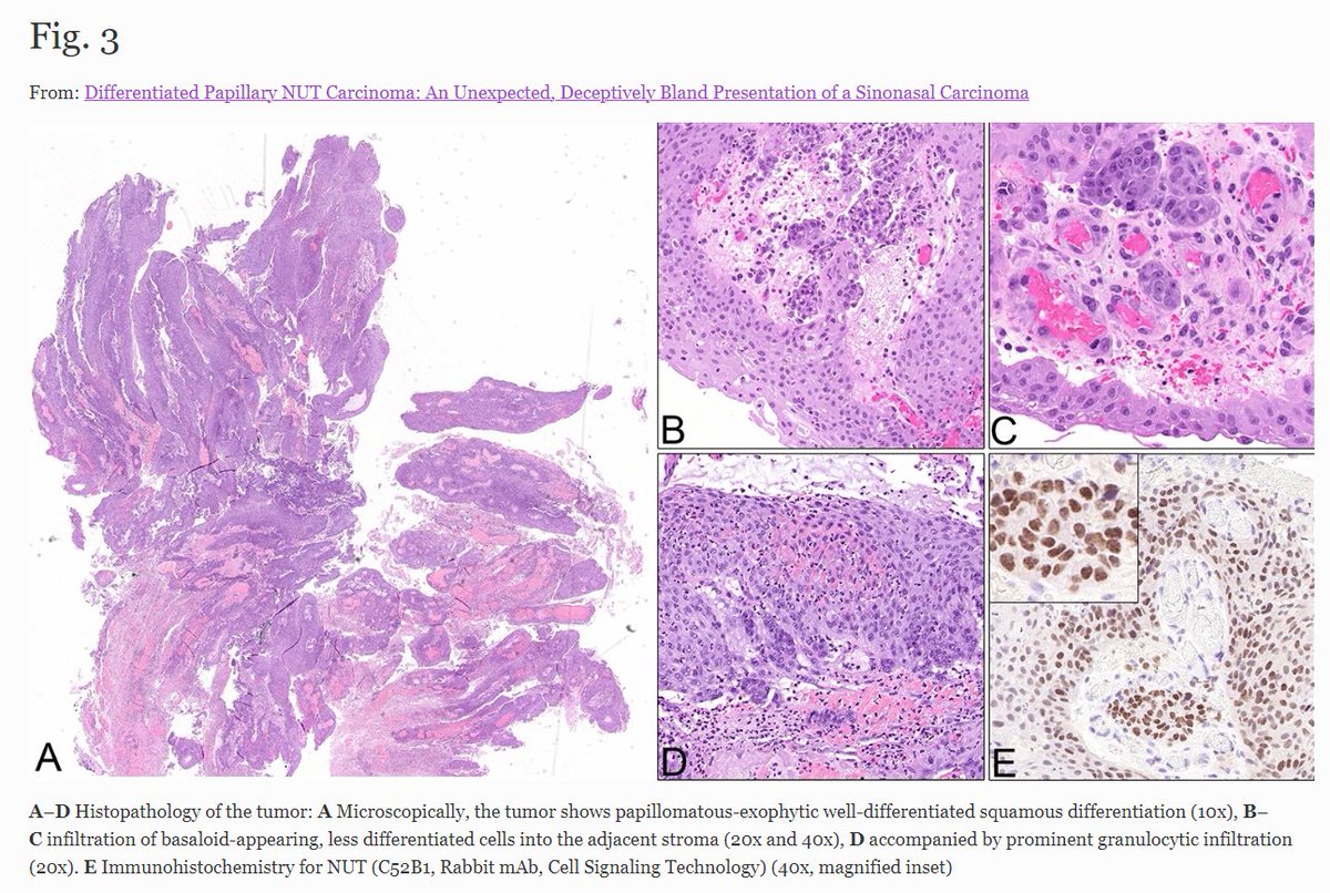 rupp_md's tweet photo. Rarely NUT carcinoma may mimic DEK::AFF2 fusion associated carcinoma or even reactive changes. Many thanks to our colleagues from Bern for summarizing this unexpected finding in a NSD3::NUT fusion positive carcinoma of the sinonasal tract. @HeadNeckPathol 
https://t.co/z3JwvVUI6Z https://t.co/NcBiJNp6dC