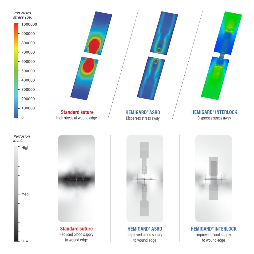 HEMIGARD devices are used across surgical specialties to reduce complications and to improve perfusion over standard sutures or staples. Over 80% reduction of dehiscence across three separate studies. #hemigard