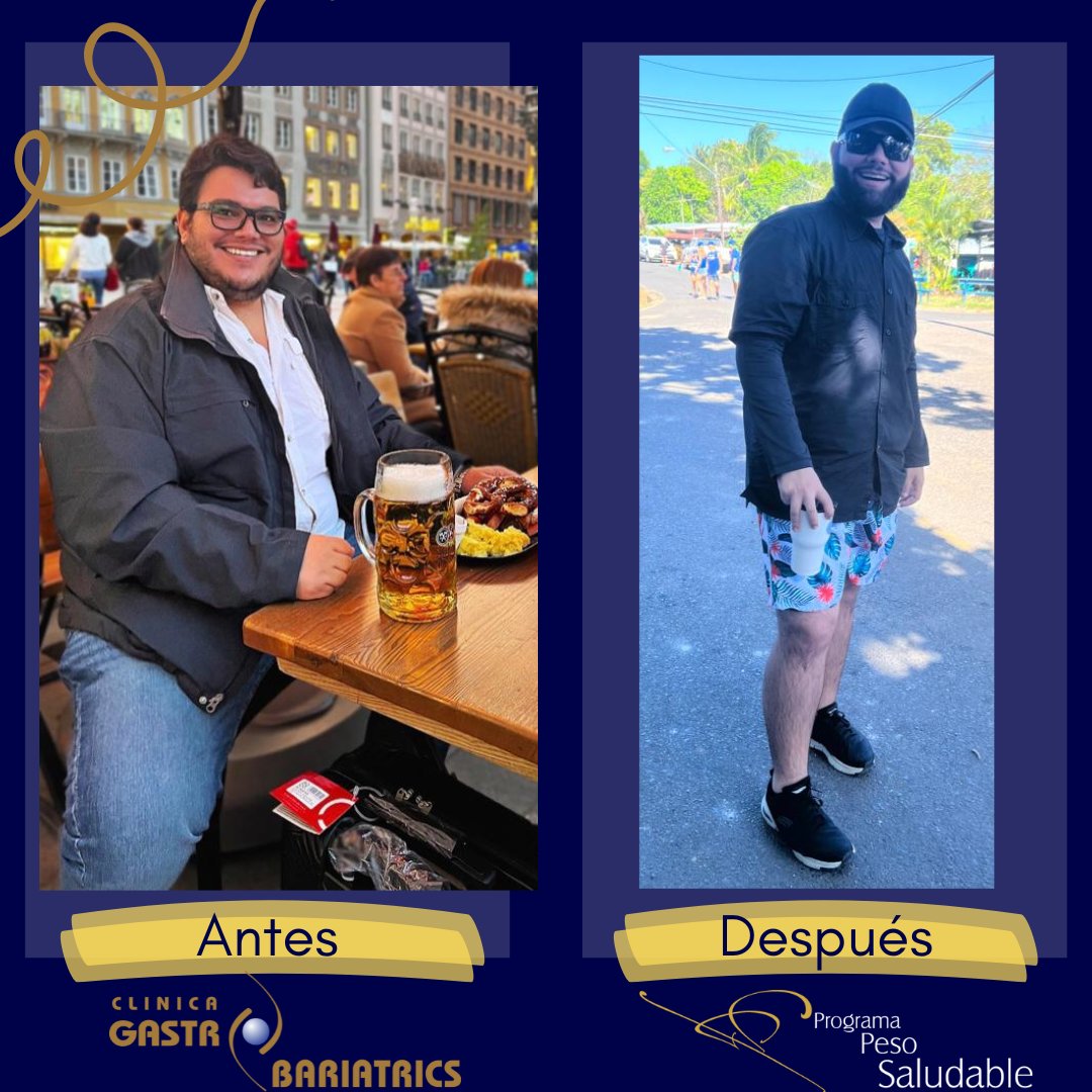 Nos llena de mucho orgullo compartir la evolución de nuestros pacientes!! 

Post operatorio 6 Meses Manga Gástrica.
 
programapesosaludable.com
#mangagastrica #sleevegastrectomy #bariatricasleeve #cirugibariatrica