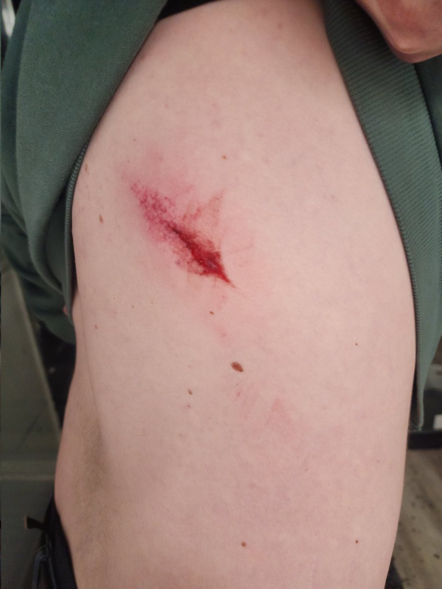 swaphamilton's tweet photo. On the evening of April 30th, one of our volunteers who helped vacate the SWAP space was accosted and assaulted by a drunk @WalterForWard3, and our volunteer sustained injuries - lacerations and bruises. We're glad to not be subject to the Furlan family's bullying &amp; harassment https://t.co/lYKxDyKKpG