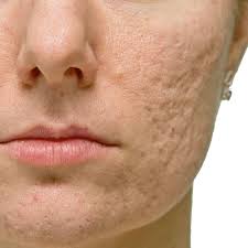 Para las cicatrices de varicela, sarampión, etc. 
Prepare una mascarilla de aloe vera natural con 1 o 2 cápsulas de vitamina E mezcladas (se abre la cápsula y se vierte el contenido en el aloe) Mantener 15 o 20 minutos y aclarar con agua tibia.
Y me van contando que tal :)