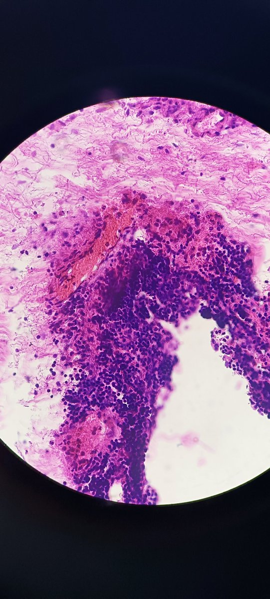 shameempath's tweet photo. 70 Male  , Mediastinal cyst 
Measuring 8.2x6.5x2.4cm 
C/S clear fluid ...
#histopathology
#cardiothorasicpathology https://t.co/NmyaWQ0azf