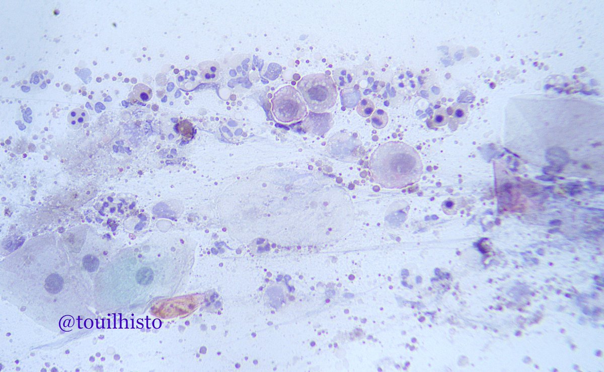 Sperm smear, from the centrifugation pellet (a case of azoospermia)