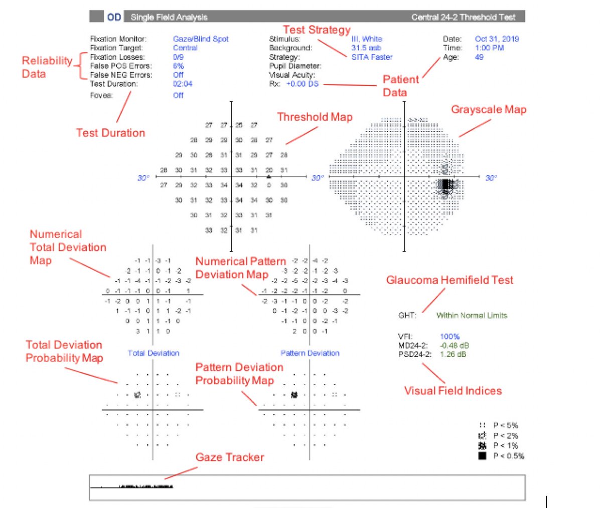 HVF interpretation is a core skill set for every eye care professional. This chapter offers great detail covering visual fields from A to Z. keogt.com/Visual_Field_T… @CUEyeCenter @OrbisIntl #ophthotwitter #glaucoma #meded