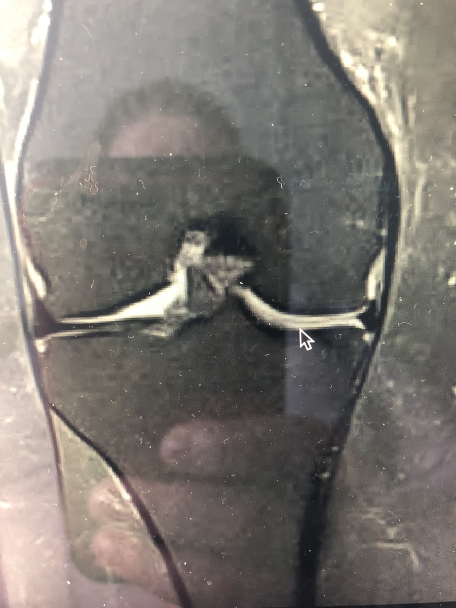 loopielou211's tweet photo. @DrNickColyvas any idea is this some sort of root tear? Can’t seem to get any answers as to what that sharp pointy bit is in my cartilage?! https://t.co/q0UCSaKK2x