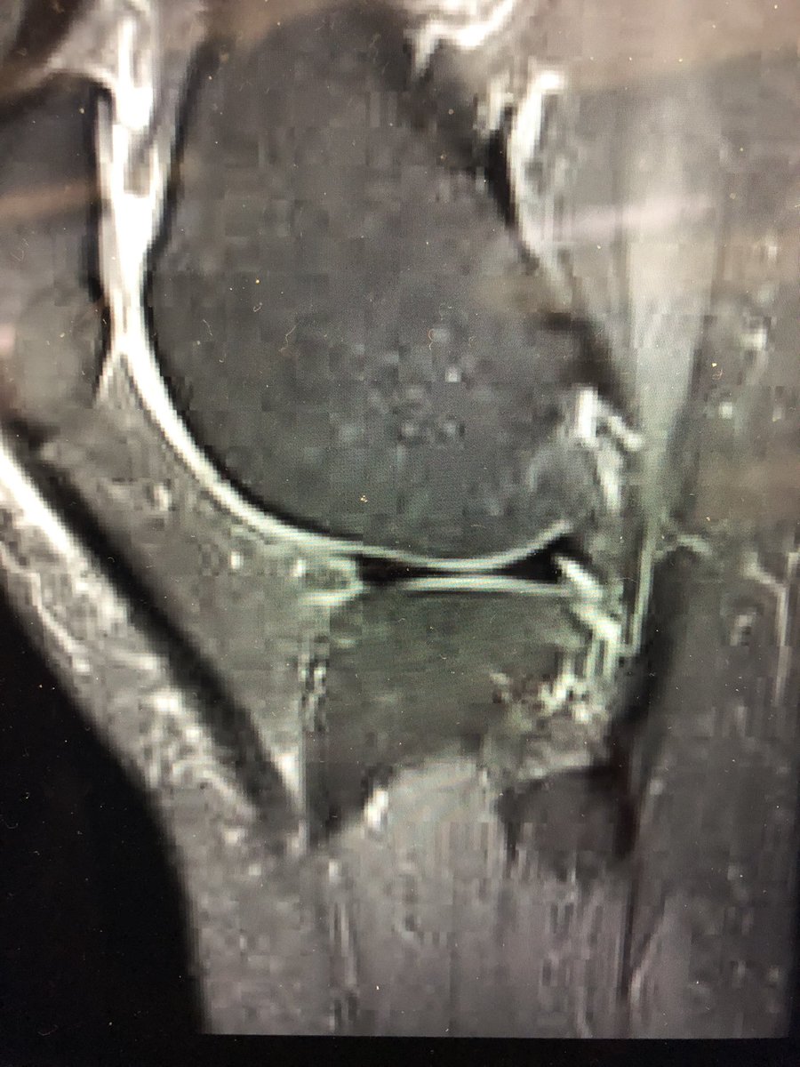 loopielou211's tweet photo. @DrNickColyvas any idea is this some sort of root tear? Can’t seem to get any answers as to what that sharp pointy bit is in my cartilage?! https://t.co/q0UCSaKK2x