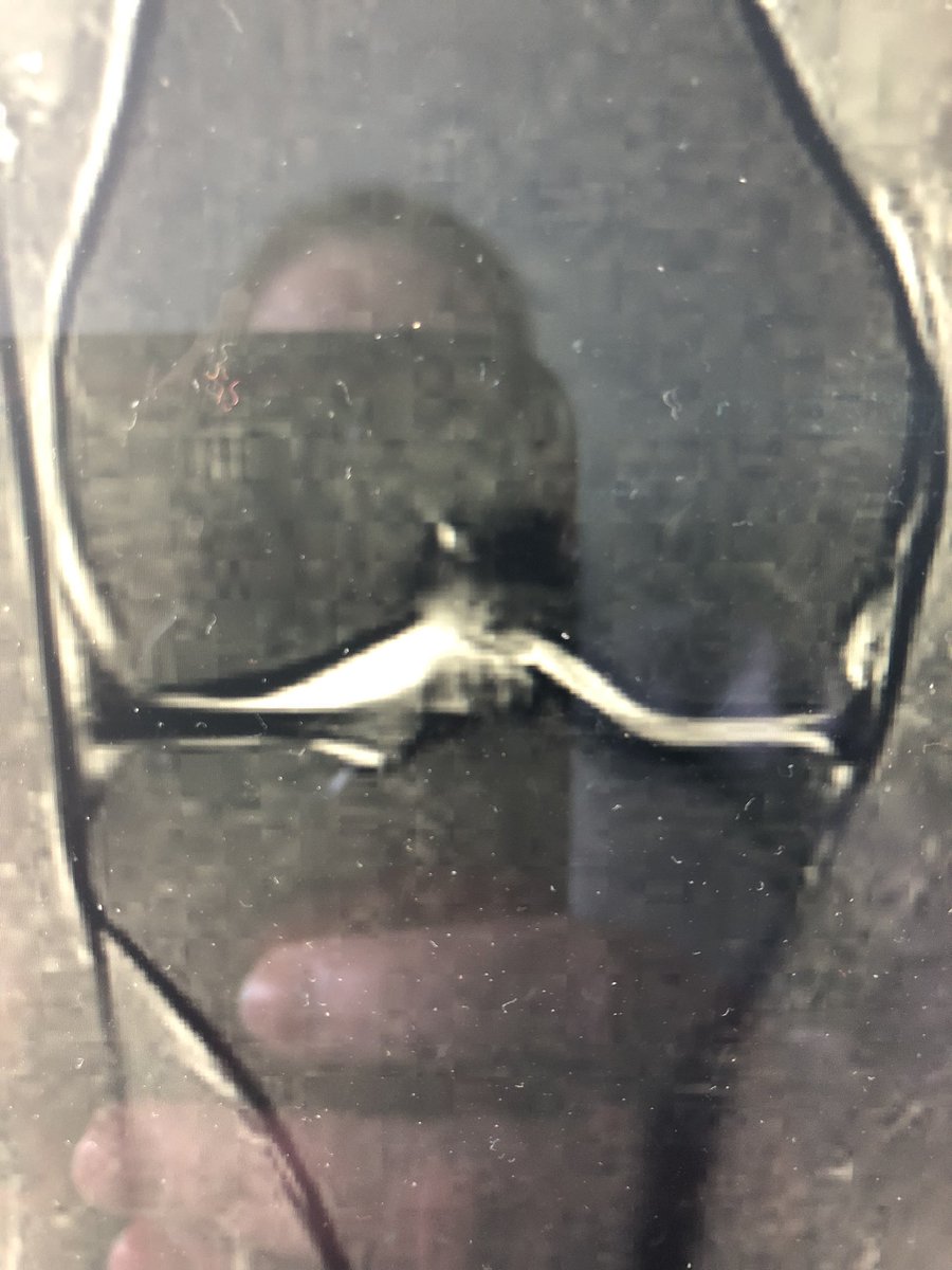 loopielou211's tweet photo. @DrNickColyvas any idea is this some sort of root tear? Can’t seem to get any answers as to what that sharp pointy bit is in my cartilage?! https://t.co/q0UCSaKK2x