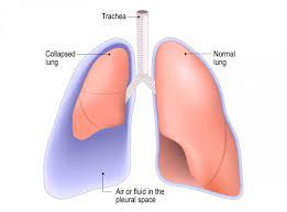 Rachael_Emefele's tweet photo. Pneumothorax is air in between the chest cavity and the lungs. Do you know how they solve this problem? Click the link to find out. @HPEX353_1 #HPEX353_1 #HRD 
https://t.co/CZbpuqNaM1 https://t.co/63MeVz2l2p