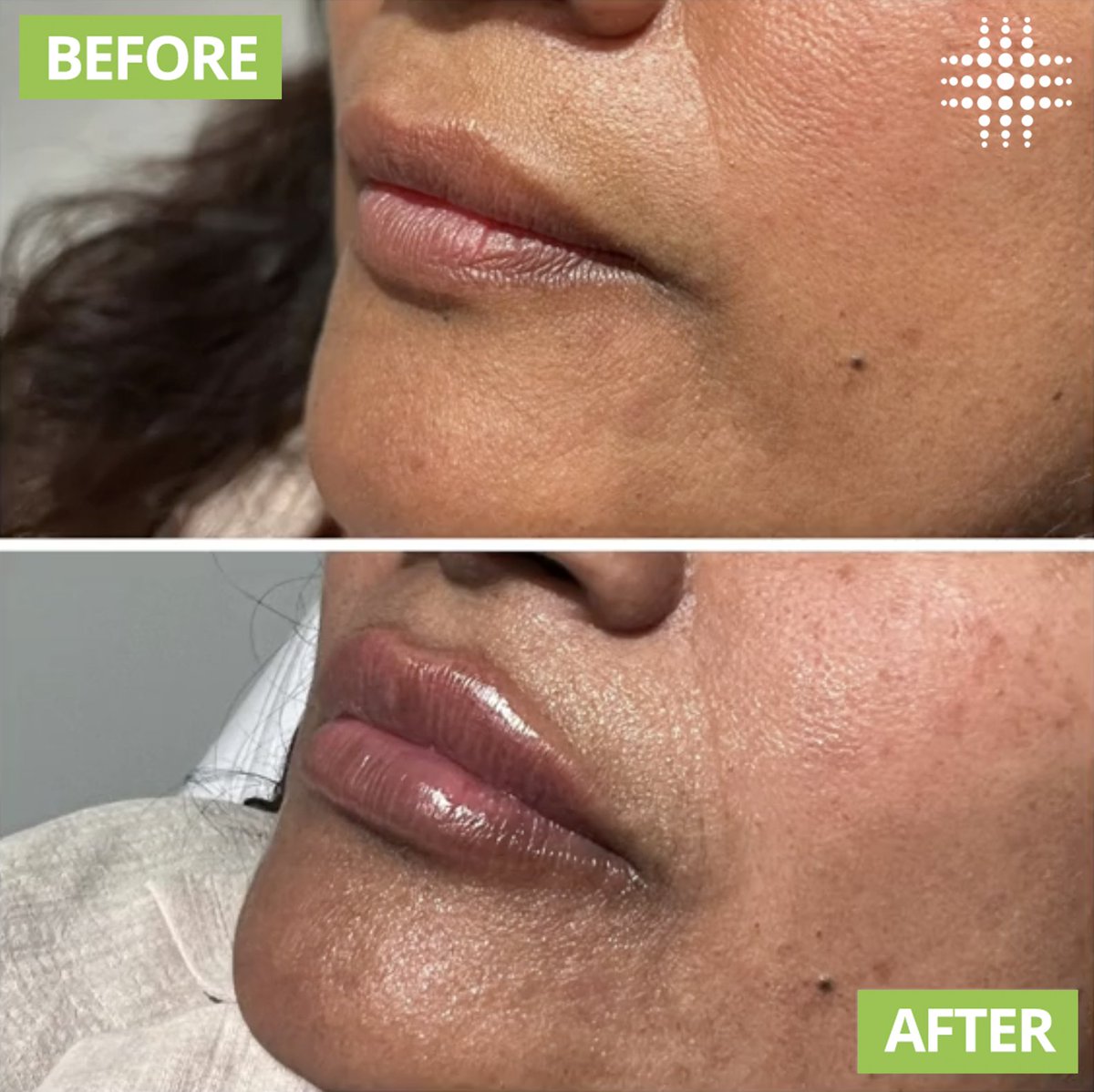 WOW 😍
Luscious lips? CHECK ✔️
Amazing results by Cosmetic Nurse Jess
instagram.com/resultslasercl…

#resultslaserclinic #sydney #australia #brisbane #melbourne #canberra #sydneycbd #victoria #newsouthwales #queensland #beauty #clinic #therapist #beautytherapist #treatments #lipfiller