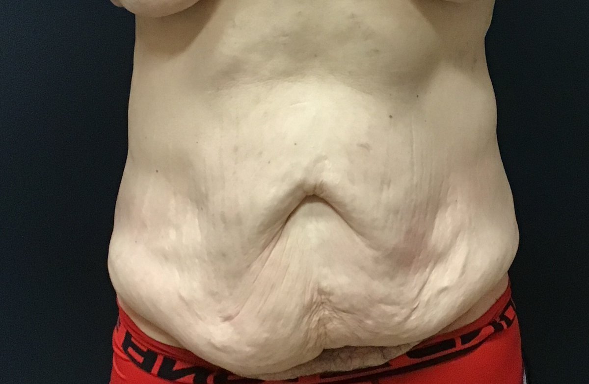 Body Contouring Surgery – Patient: Mid 40's male who underwent a gastric sleeve pro... google.com/maps/place/Kev…