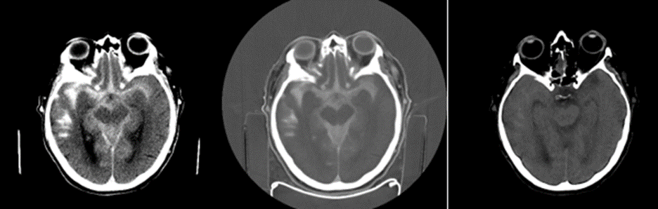 rkchoi's tweet photo. 7/ #dualenergyCT is obtained post op to assess for post-thrombectomy bleeding: (Left non-con; Middle iodinated contrast; Right post contrast removal). https://t.co/AqlXfLvdQy