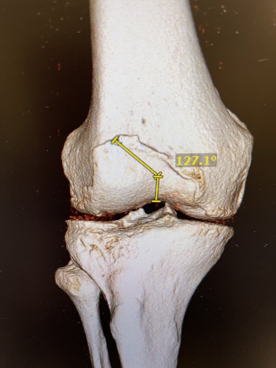 3D trochlea dysplasia is here Too complex to comprehend in 2D-here’s the entry point-transition point angle of Yu. In trochlea dysplasia, the patella often has a long journey before it can fully engage with the trochlea. Better to move patella than deepen a congruous trochlea