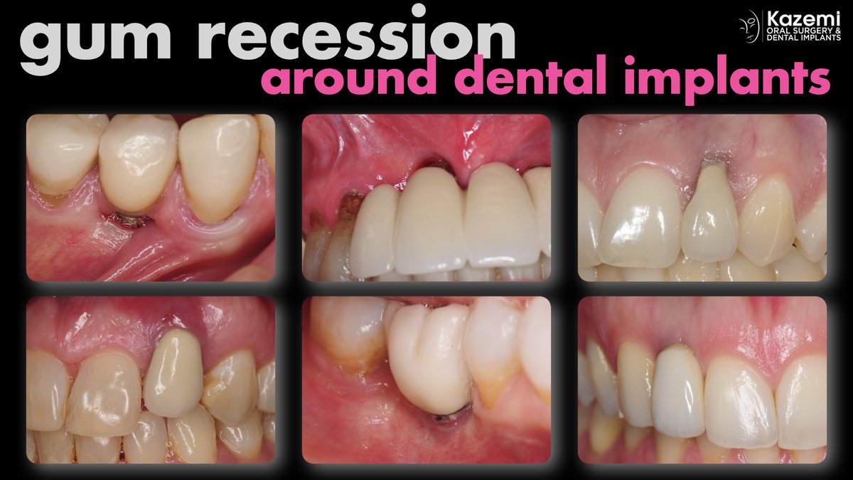 Gum recession around dental implants can result in aesthetic and functional complications. In this video we discuss primary causes as well as main treatment options. #dental #dentalimplant #gumrecession 

facialart.com/library/patien…