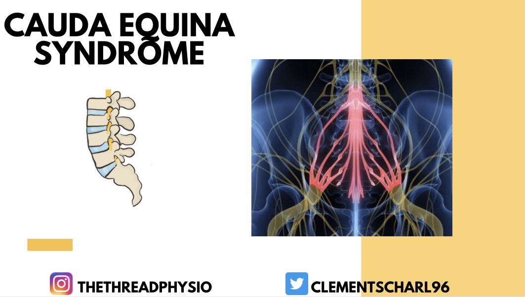 1) A very quick look 👀 at the stages of Cauda Equina Syndrome (CES)