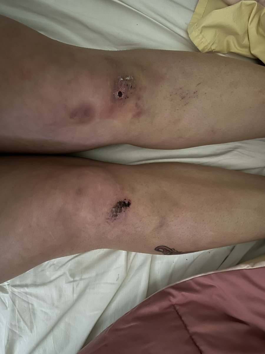 blessedbymaria's tweet photo. I have fallen two or three more times since my last tweet, and today I was asked what happened from my doctor. I decided to admit I’m a clumsy motherfucker. My doctor said “next time, you need to come up with a better explanation” 🥴 bitch, what?! https://t.co/RkRVOdhuCz