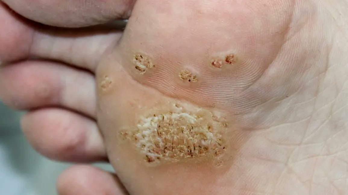 Warts are a type of skin infection caused by the human papillomavirus (HPV). The infection causes rough, skin-colored bumps to form on the skin. 
For daily updates follow us: lnkd.in/dupYRKPB

#warts #skin #infection #humanpapillomavirus #mostcommonly  #dermatology