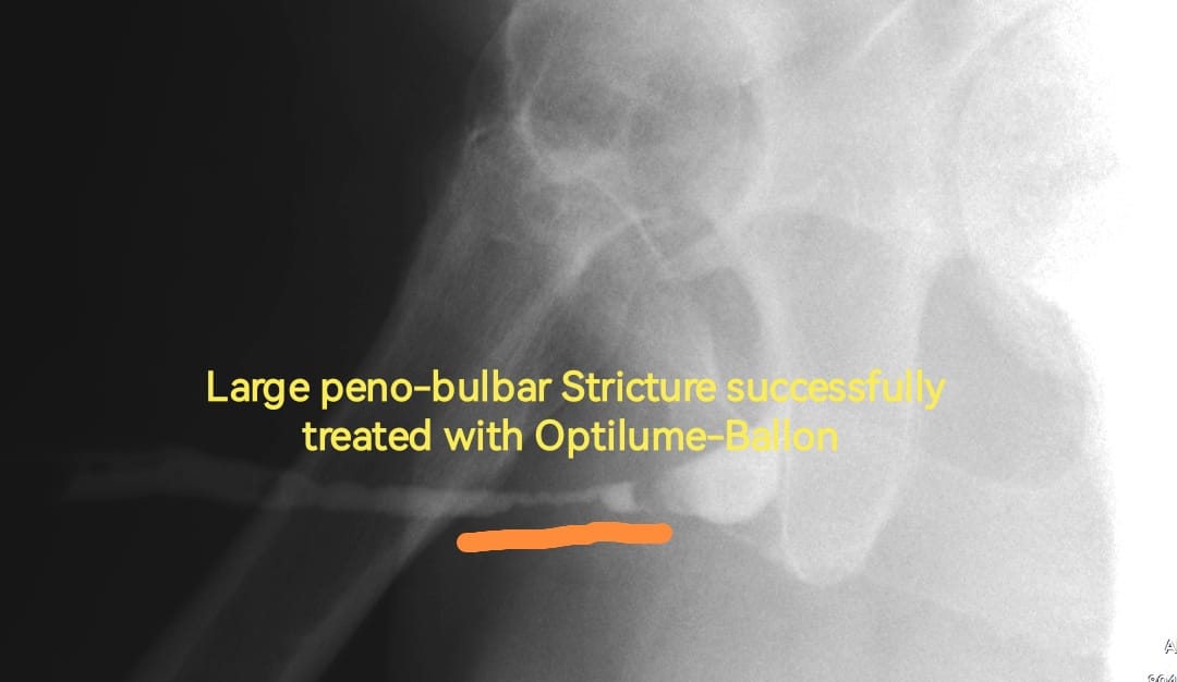 OTosev's tweet photo. Large peno-bulbar stricture successfully treated with #Optilume-Balloon by https://t.co/Kp4p9GaadA.univ.Georgi #Tosev, which led to significant improvements in the patient’s #uroflowmetry 1 week after the treatment. https://t.co/JSehxZAr5t