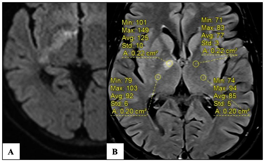 vebinars_neuro's tweet photo. ✅FLAIR signal intensity ratio(SIR) <1.15 yields a practical estimate of stroke onset within 4.5 hours-may be eligible for thrombolysis with improved outcomes
#vebinars #value_based_imaging #evidence_based_medicine #NeuroRad #Neurology #stroke #FOAMrad #neurotwitter #radres https://t.co/Kz2OQfxeIX