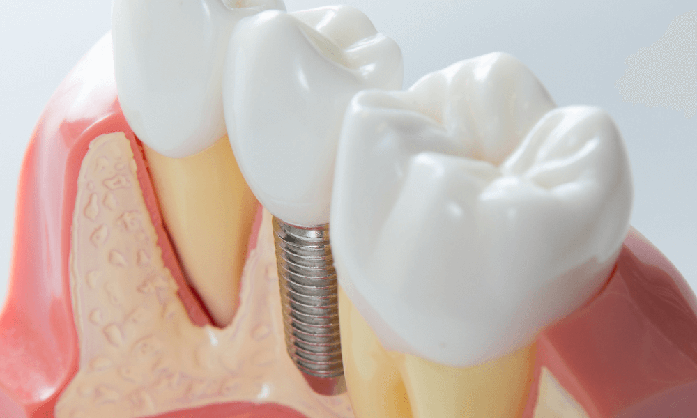 AllSmilesAllen's tweet image. $100 off Single tooth dental implant procedure. Dental Implants are the best way to replace missing teeth. If you are missing a tooth, Book a Free Consult to see if a dental implant is right for you.
bit.ly/3YSyHce