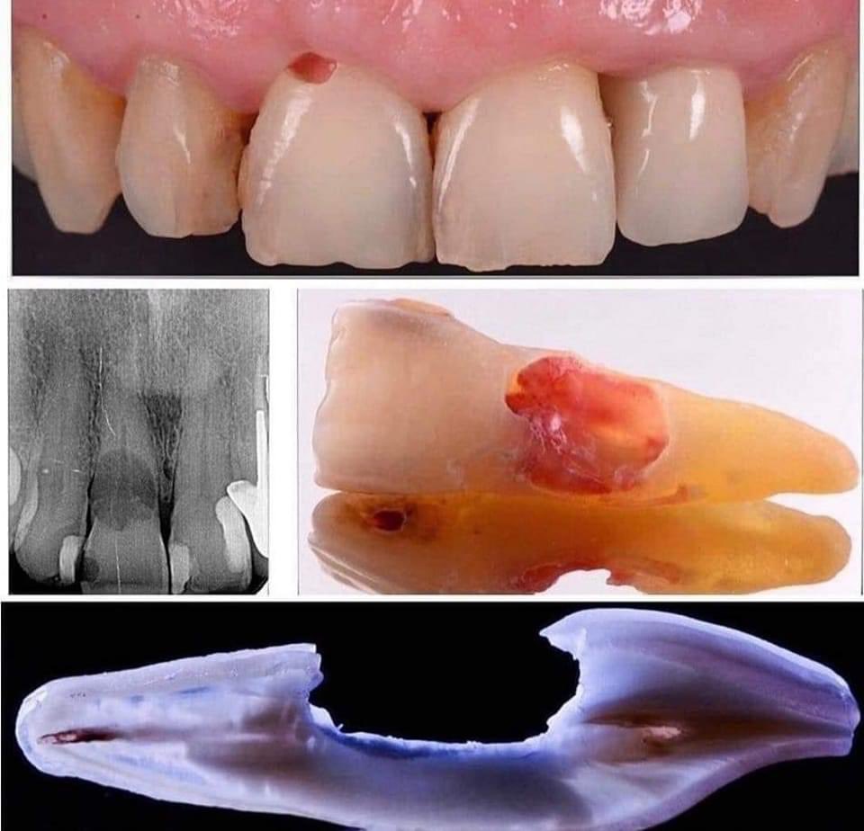aboutDent's tweet photo. “Never say just simple caries!!
Before x-ray” https://t.co/efHGG5OFSP