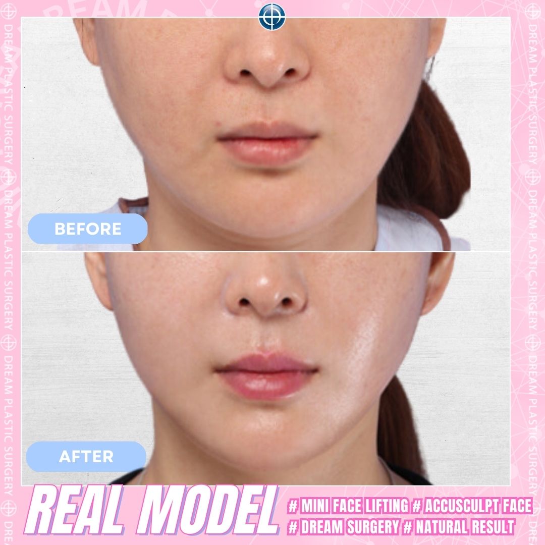 dreamprs_eng's tweet photo. #plasticsurgery #dreamplasticsurgery #rhinoplasty #nosejob #nosesurgerys #koreanplasticsurgery #koreaplasticsurgeryreview #beforeandafter #koreaplasticsurgerybeforeandafter #surgerybeforeandafter #beforeandafterchallenge #prettygirls #facelifting #antiageing #facelift #oldyoung https://t.co/9gHPeo25JK
