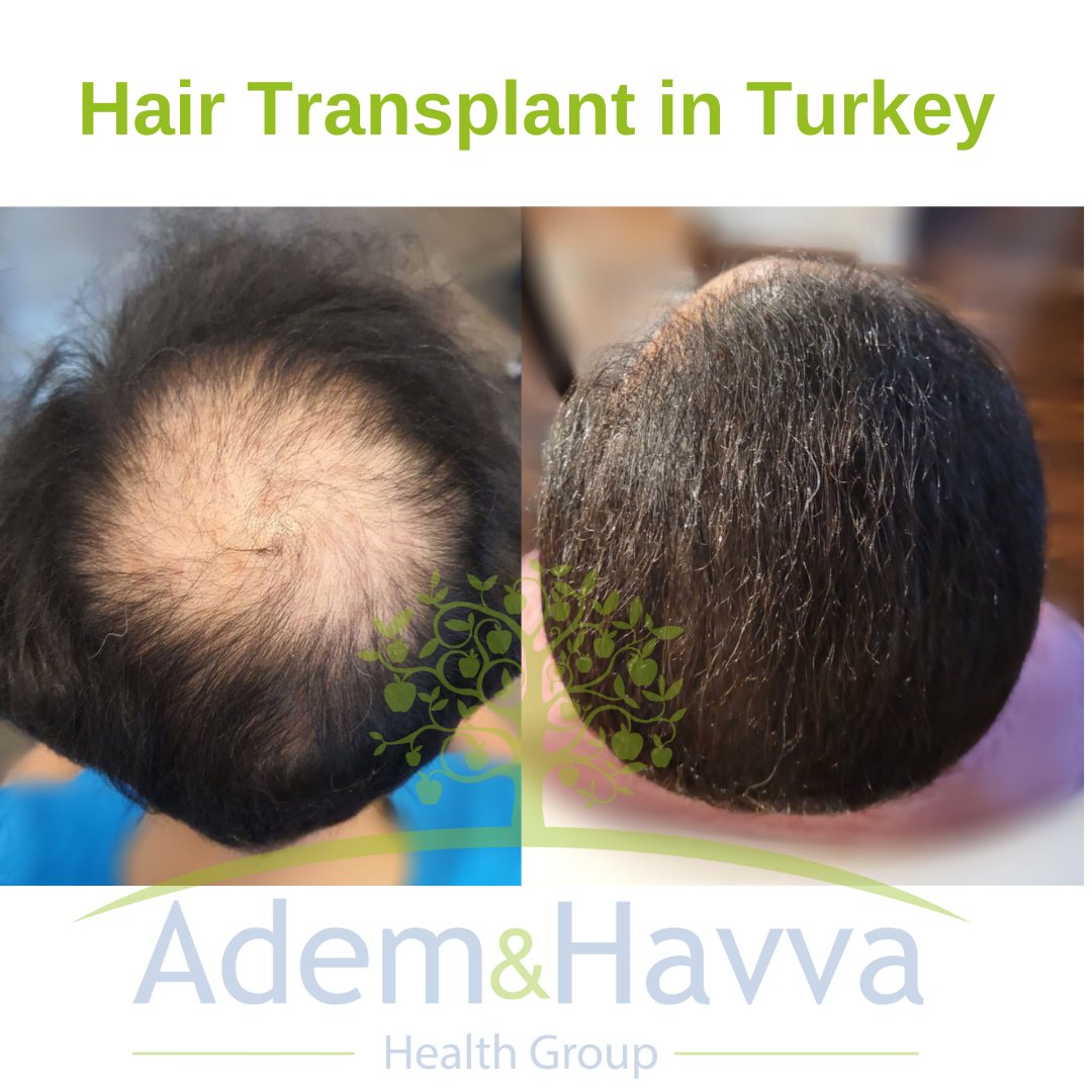 AdemHavvaHealth's tweet photo. Adem &amp; Havva Clinic has been conducted over 20.000 hair transplantation as well as plastic surgeries.
https://t.co/RsONhawLPD

#HairTransplant #hairtransplantation #пересадкаволос #hairtransplantinturkey 
#hairtransplantinistanbul #greffedecheveux #fuehairtransplant #beforeafter https://t.co/gZNH7wBzxn