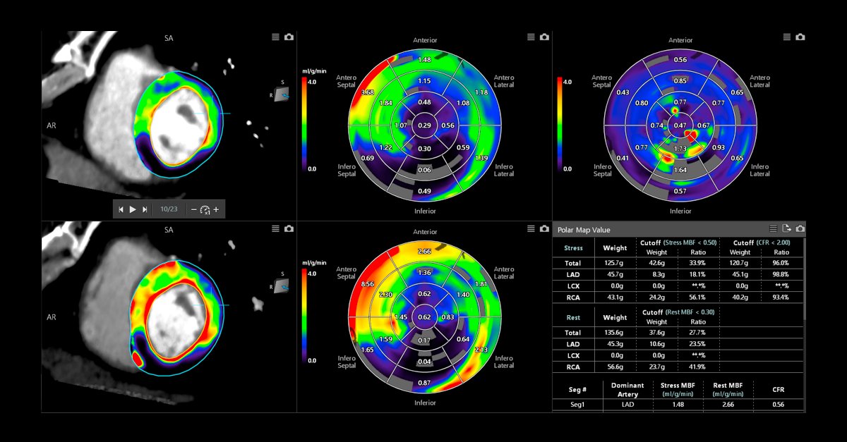 TriBruSan's tweet photo. CanonMedicalEU: How can you use Dynamic Myocardial Perfusion to evaluate myocardial ischemia in patients with coronary artery disease? Get the answer at our booth during #EAVCI and join our stage presentation!

More info: https://t.co/aP92y4KWrJ

#MadeP… https://t.co/7NWxZF9DPu